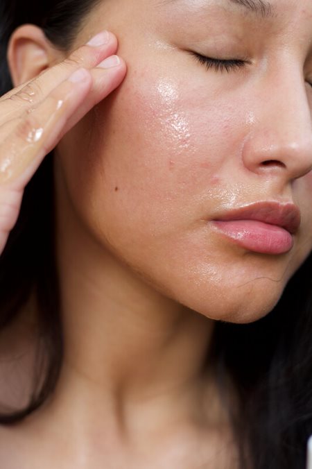 How to Get Rid of Acne Scars Quickly and Easily?